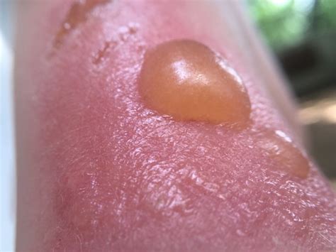 why is my sunburn leaking yellow|Sunburn Bubbles: What They Are & How to Treat Them